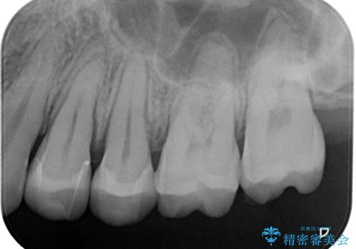 奥歯の着色が気になる セラミック治療の治療後