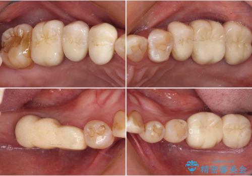 治療後に歯茎から出血 インプラントとオールセラミッククラウンの補綴治療の症例 治療前