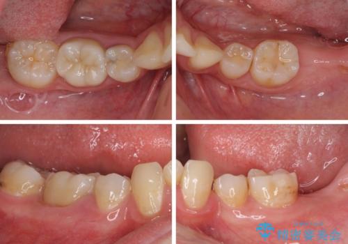 部分矯正を併用した奥歯のインプラント治療の治療前
