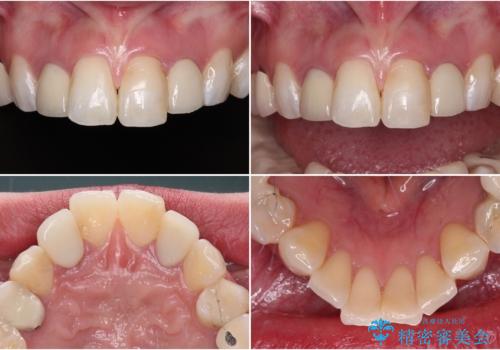金属の見えてしまったクラウン セラミッククラウンで自然にの治療前