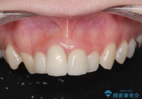 [ セラミック治療 ]前歯を審美的に治して欲しいの症例 治療後