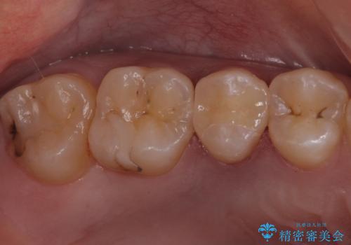 症状のない虫歯　セラミックインレーでの治療の症例 治療後