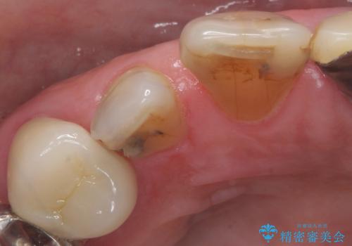 大きい虫歯で欠けた前歯　セラミッククラウンで治療の治療前