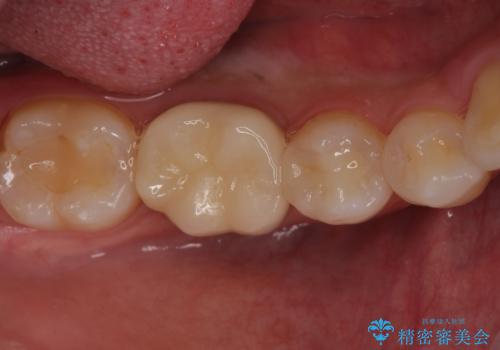 銀歯のやり替え　セラミックで白い歯にの治療後