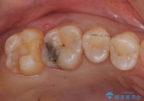 奥歯の虫歯　セラミックインレーによる治療の治療中