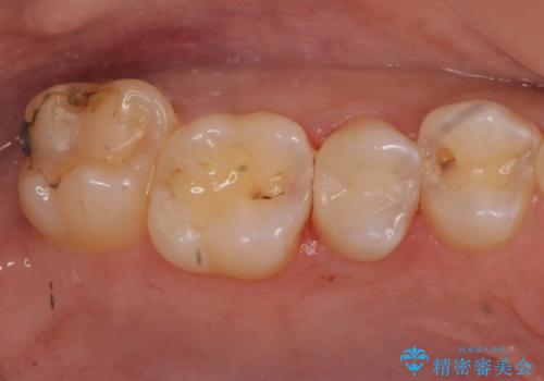 検査で見つかった虫歯 セラミックインレーでの治療の治療後