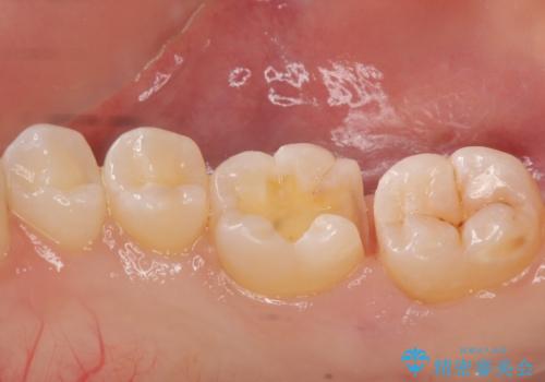 奥歯の虫歯　セラミックインレーによる治療の治療中