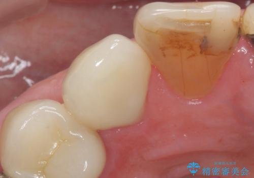 大きい虫歯で欠けた前歯 セラミッククラウンで治療の治療後