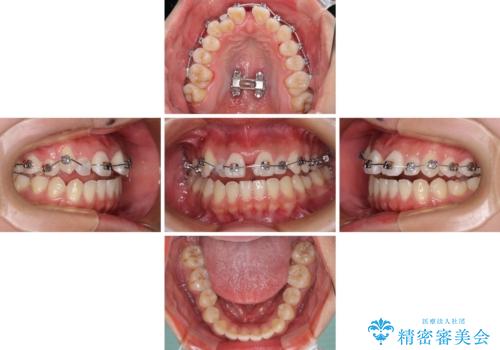 急速拡大装置 狭い上顎骨を拡大してワイヤー装置で短期間治療の治療後
