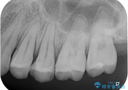 奥歯の着色が気になる セラミック治療の治療前