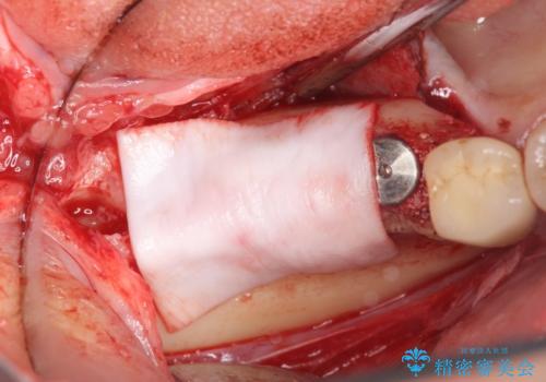 臼歯部インプラント治療の治療中