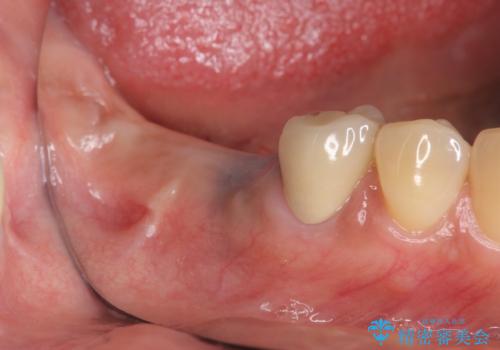 臼歯部インプラント治療の症例 治療前