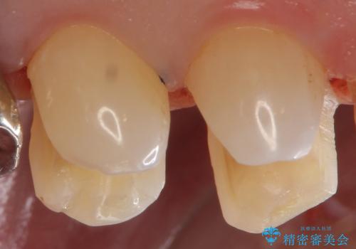 外から見える銀歯 セラミックでのやり替えの治療中