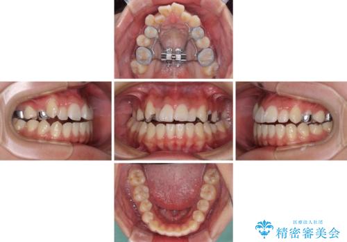 急速拡大装置 狭い上顎骨を拡大してワイヤー装置で短期間治療の治療前