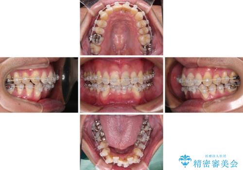ワイヤー装置をインビザラインへ 装置変更での矯正治療の治療中