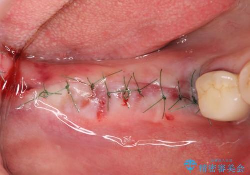 臼歯部インプラント治療の治療中