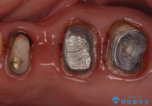 銀歯を白くしたい セラミックブリッジでの治療の治療中