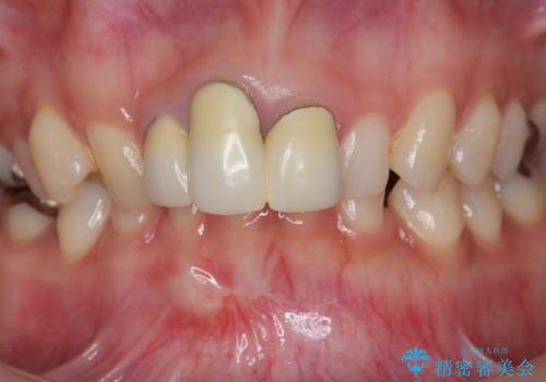 [ セラミック治療 ]前歯を審美的に治して欲しいの治療前