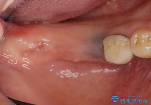 臼歯部インプラント治療の治療前