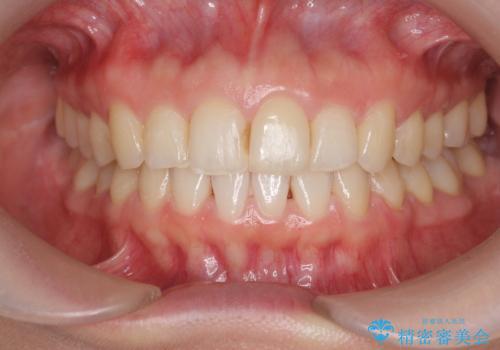 前歯のガタつきをきれいに　マウスピース矯正治療の症例 治療後