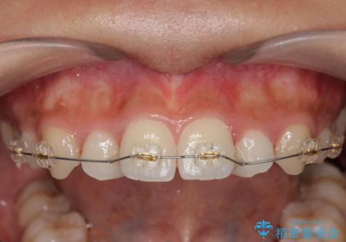 ワイヤー部分矯正を併用して治療期間を短縮 マウスピース矯正治療の治療前