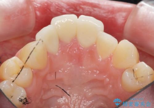 [ セラミック治療 ]前歯を審美的に治して欲しいの治療後