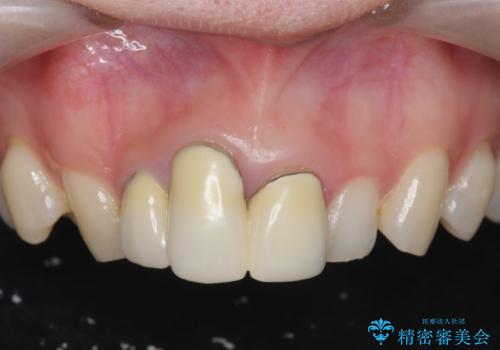 [ セラミック治療 ]前歯を審美的に治して欲しいの症例 治療前