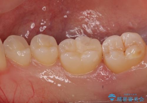 奥歯の虫歯　セラミックインレーによる治療の治療後