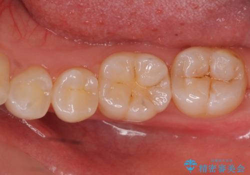 奥歯の虫歯　セラミックインレーによる治療の治療前