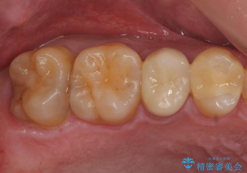 放置していた虫歯 セラミックインレーによる治療の症例 治療前