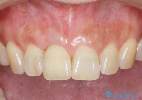 骨造成を伴う前歯のインプラント治療の症例 治療後