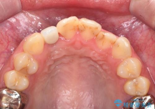 前歯の虫歯 オールセラミック治療の治療前