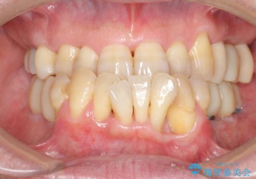 インプラント治療を併用した全顎歯周病治療の治療中