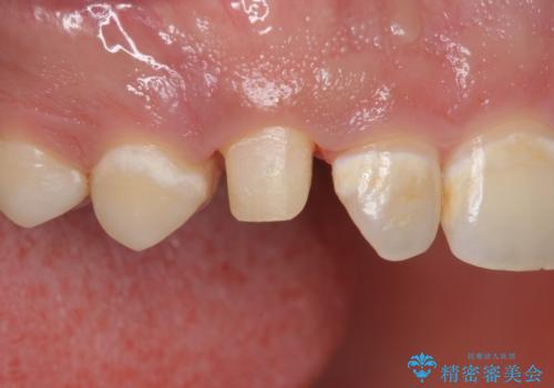 穴が開いた前歯 白いクラウンで修復の治療中