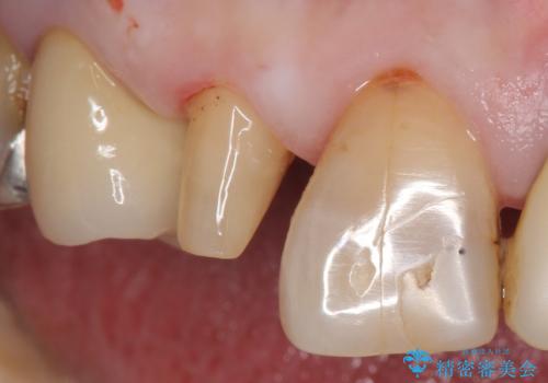 大きい虫歯で欠けた前歯 セラミッククラウンで治療の治療中