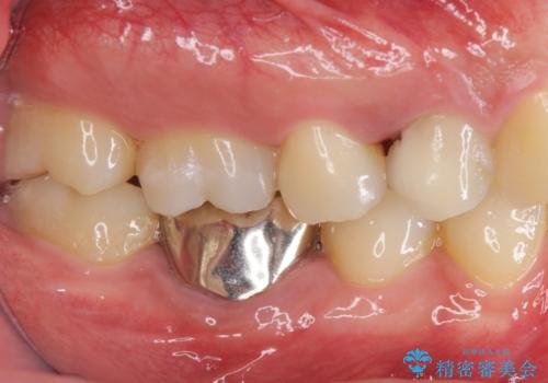 銀歯のやり替え セラミックで白い歯にの治療前