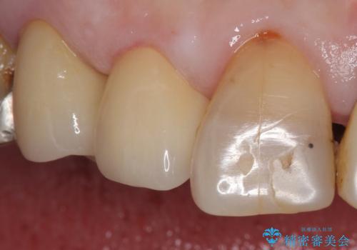大きい虫歯で欠けた前歯 セラミッククラウンで治療の治療後