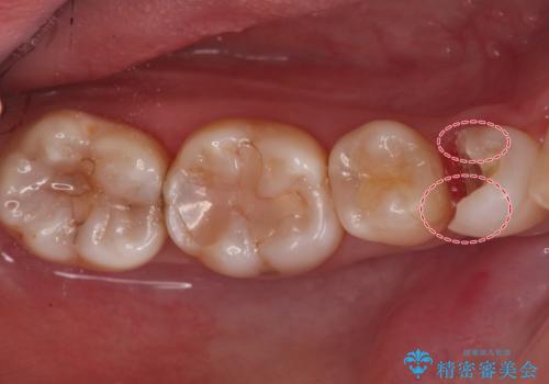 銀の詰め物をオールセラミックで白くしたいの治療中