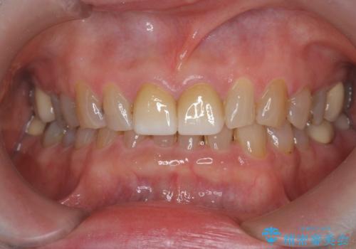 目立つ前歯の変色を改善したいの治療後