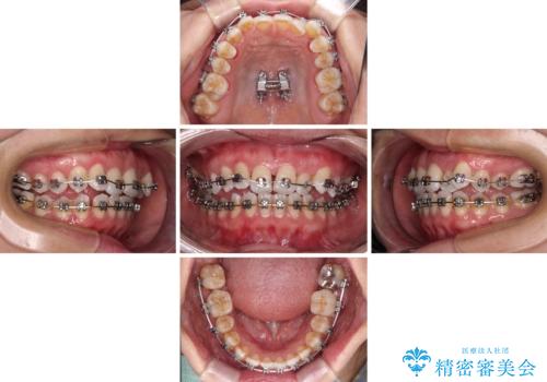 前歯の反対咬合 急速拡大装置とワイヤー装置であっという間の矯正治療の治療中