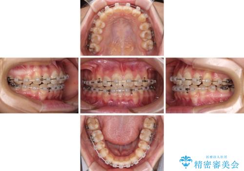 目立つ八重歯を治したい インビザラインによる矯正治療の治療中