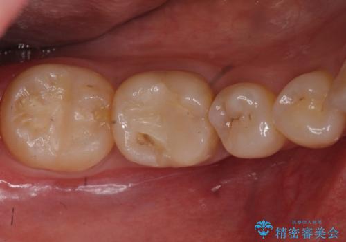 欠けた詰め物 セラミッククラウンでの修復の症例 治療前