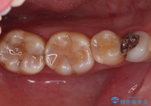 銀の詰め物をオールセラミックで白くしたい