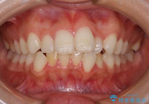 【モニター】前歯のクロスバイトをインビザラインで治療の症例 治療前