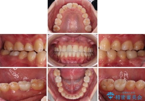 虫歯と抜いたままの奥歯とデコボコの前歯 総合歯科治療の治療後