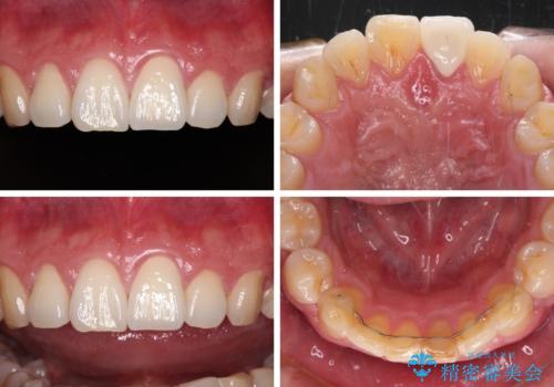 気になる前歯を短期間で改善 下顎の部分矯正と上顎のオールセラミッククラウンの治療後