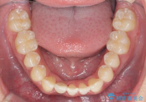 [ 先天性の前歯欠損 ]  マウスピース矯正とインプラント治療の治療後