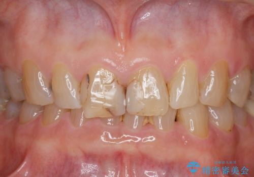 目立つ前歯の変色を改善したいの治療前