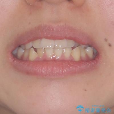 狭い歯列を拡大　拡大装置を併用したインビザライン矯正の治療前（顔貌）