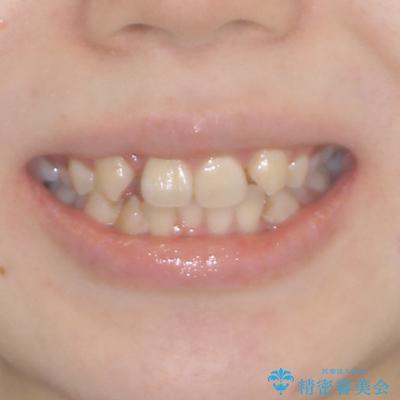 見えないほど重なっている前歯 抜歯矯正でスッキリとした歯並びにの治療前(顔貌)